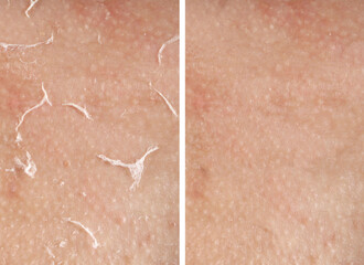 Fototapeta premium Dry skin before and after moisturizing, marco view. Collage for comparison