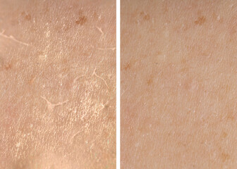 Fototapeta premium Dry skin before and after moisturizing, marco view. Collage for comparison