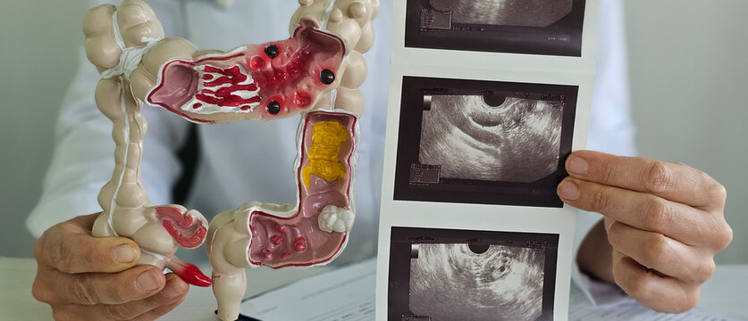 Doctor Examining a Colon Model and Ultrasound Images