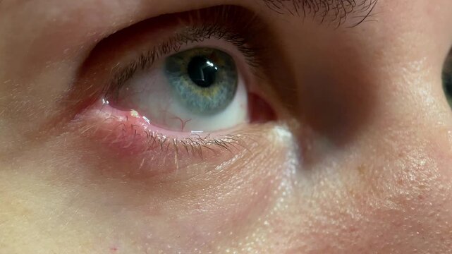 Close-up shot of an eye with a visible lower eyelid stye showing redness and swelling. Ideal for medical, ophthalmology, health education, and dermatology content.