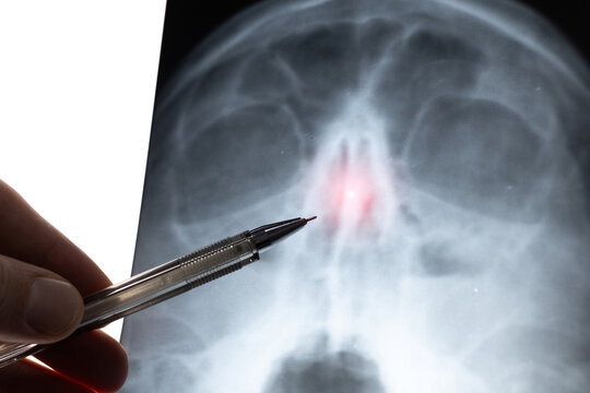 Doctor learning medical X-ray of head Injury. Deviated Nasal Septum. Nose trauma.