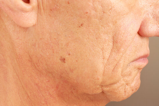 Mature man with age spots or liver spots on the side of his face likely cause from sun exposure