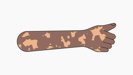 Vitiligo thumbs up hand, gesture collage element vector