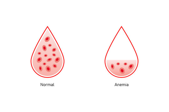 Anemia Disease Science Design. Vector Illustration.