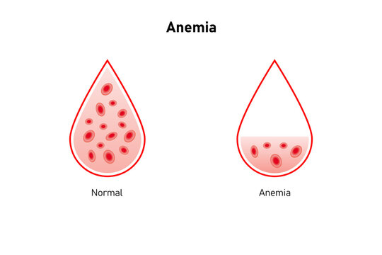 Anemia Disease Science Design. Vector Illustration.