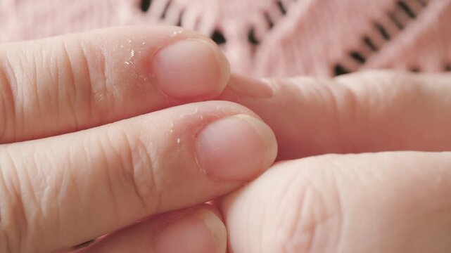 hangnails on fingers, skin scrap, area of ​​exfoliated epidermis surrounding nail, Compulsive nail and cuticle biting, Stress relief or self-harm, obsessive-compulsive disorder, mental health