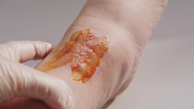Doctor applying healing ointment to recovering wound on woman leg, treating female ankle, medical treatment skin injury, healthcare support and recovery rehabilitation, patient care, injury healing