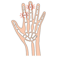 へバーデン結節とブシャール結節