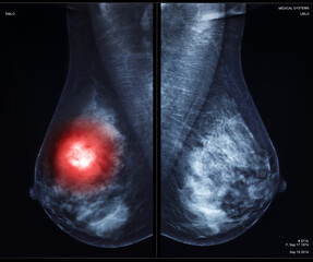 Breast X-ray showing tumor on the left side with contrast highlighting detected mass. X-ray digital...