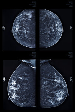 X-ray mlo mammography for breast cancer, checking breasts. X-ray image of the breast in women, breast scan.