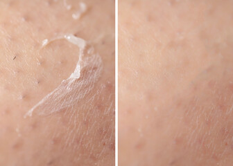 Fototapeta premium Dry skin before and after moisturizing, marco view. Collage for comparison