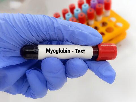 Doctor  holding a test blood sample for Myoglobin - test. Laboratory medical testing concept.