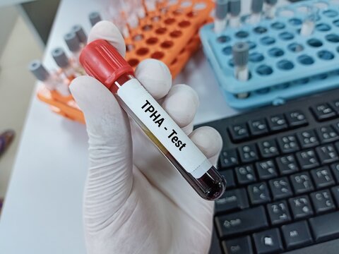 Doctor  holding a test blood sample for TPHA - test. Laboratory medical testing concept.