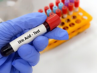 Lab Technologist hold blood sample for Uric Acid  test. Laboratory medical testing concept. 