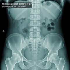 Anterior-posterior x-ray showing lumbar spine and pelvic bones