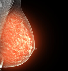  X-ray Digital Mammogram of Both side CC view and MLO view showing multiple cysts and complicated cysts scattered at bilateral breasts. BI-RADS CATEGORY 3: Probably benign.