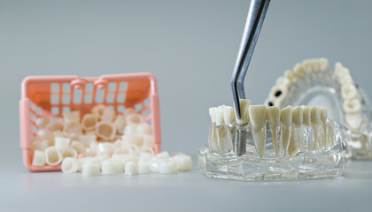 Dental Crown Placement with Tweezers and Tooth Basket