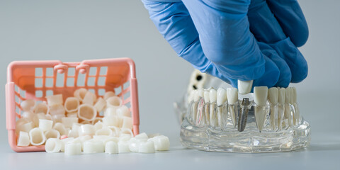 Dental Crown Placement on Implant Model with Gloved Hand