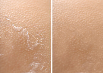Dry skin before and after moisturizing, marco view. Collage for comparison