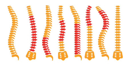 comparing different human spine shapes with correct and 