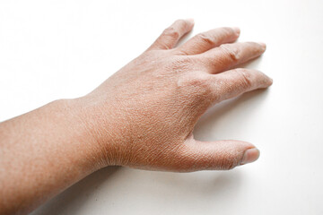 Elderly woman dry hand skin. Skin problem in the elderly. Winter season cause dried skin problems.