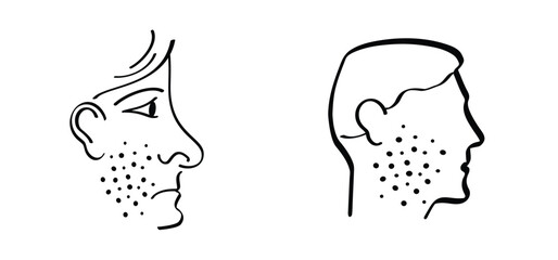 Skin rash, measles on face. Red rash on the body. Sign of measles, lupus, herpes, or rubelaa, and other autoimmune diseases. Rubeola or morbilli symptom. food allergy. Red spots on body. Acne on face