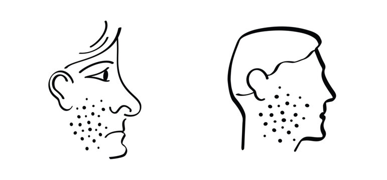 Skin rash, measles on face. Red rash on the body. Sign of measles, lupus, herpes, or rubelaa, and other autoimmune diseases. Rubeola or morbilli symptom. food allergy. Red spots on body. Acne on face