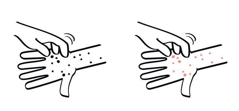 Skin rash, measles on hand. allergy causing itching, skin irritation. Red rash on the body. food allergy orother autoimmune diseases. Rubeola or morbilli symptom. food allergy. Eczema, smallpox.