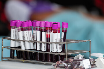 Close up of blood samples in test tubes with purple caps arranged in a metal rack at a laboratory. Medical analysis and health testing concept for diagnosis, research, and clinical examination.