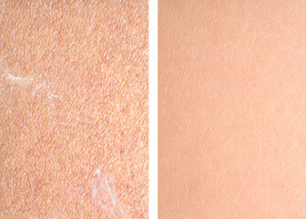 Fototapeta premium Dry skin before and after moisturizing, marco view. Collage for comparison