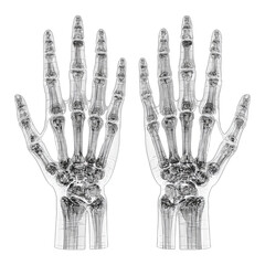 X-ray images of two human hands, showing bones and joints