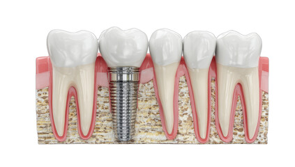 Anatomical illustration showcasing dental implant, neighboring teeth, and gum structure