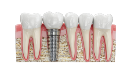 Anatomical illustration showcasing dental implant, neighboring teeth, and gum structure