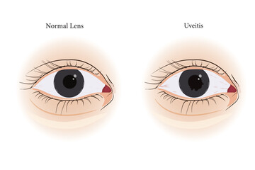 Medical illustration comparing a normal eye to uveitis inflammation with visible iris changes. eps 10