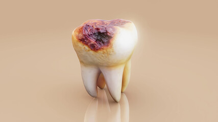 Conceptual 3D illustration of a decayed tooth