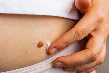 Birthmarks and sun exposure effects on skin health