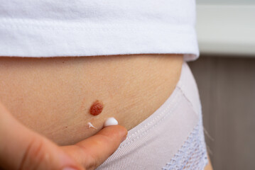 Birthmark on skin highlighting sun protection