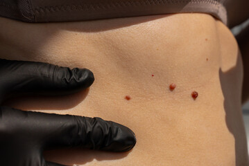 Birthmarks on skin indicate sun exposure effects