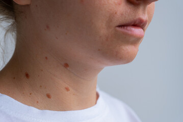 Birthmarks on skin showcasing sun exposure effects