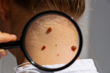 Skin examination through magnifying glass for melanoma check