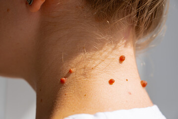 Birthmarks and skin examination for melanoma prevention