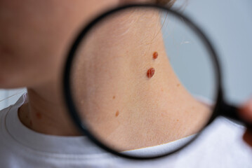 Birthmarks and sun exposure prevention concept