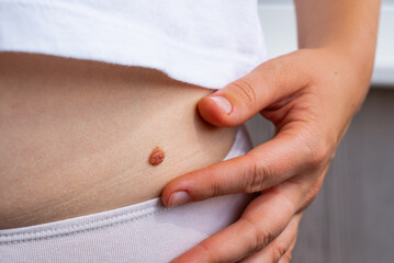Importance of skin check ups for birthmarks