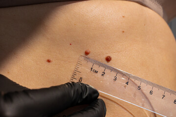 Birthmarks and sun exposure effects on skin