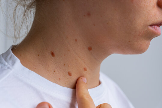 Birthmarks and skin health awareness for sun exposure