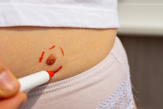 Birthmarks and skin health awareness concept