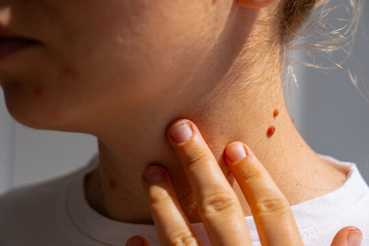 Sun exposure effects on skin with birthmarks