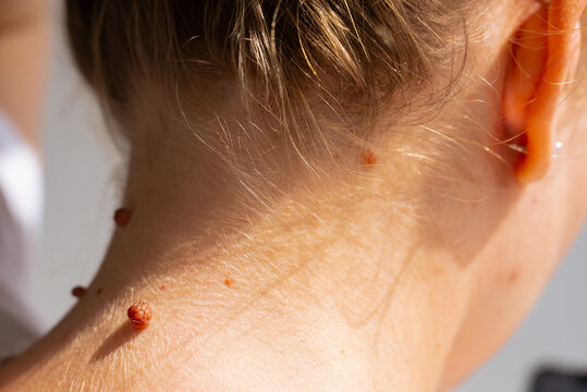 Birthmarks on a woman body related to sun exposure