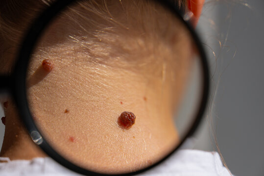 Birthmarks and sun exposure effects on skin health