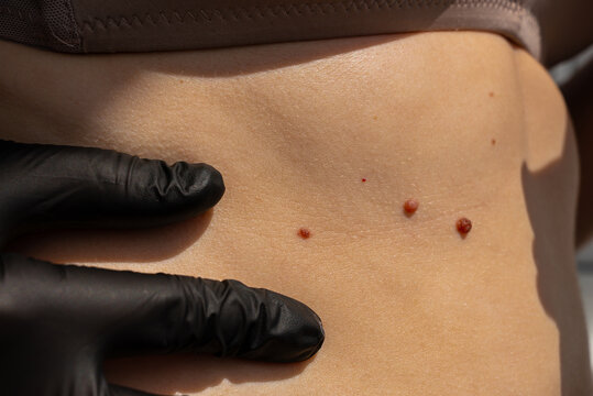 Birthmarks on skin indicate sun exposure effects